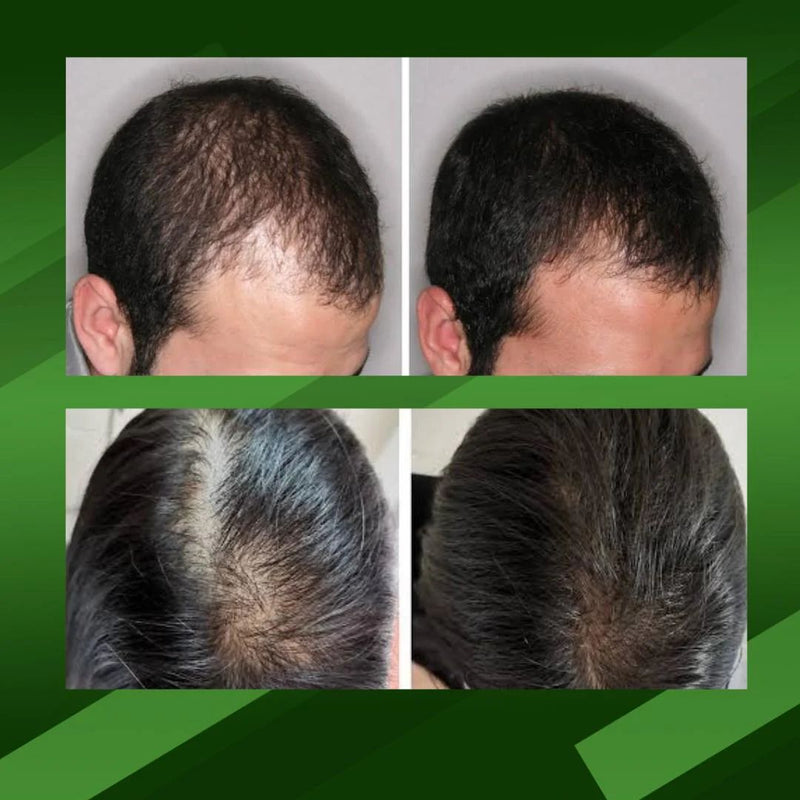 OUHOE | Elixir de crecimiento y reparación capilar